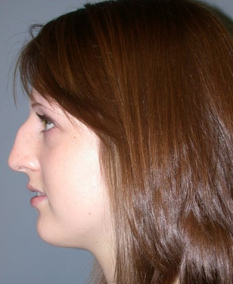 18-24 year old woman treated with Rhinoplasty before 3710447