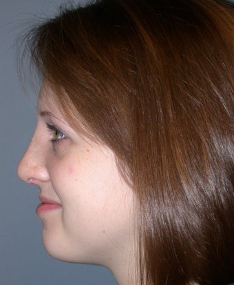 18-24 year old woman treated with Rhinoplasty after 3710447