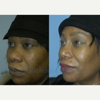 45-54 year old woman treated with Rhinoplasty after 1754845