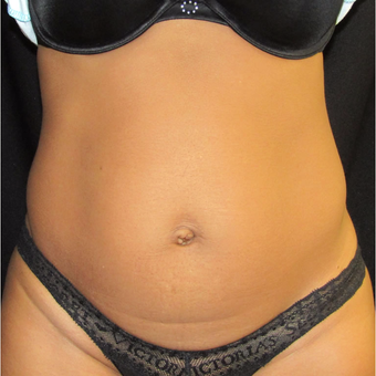 41 yr old woman treated with CoolSculpting on the abdomen and flanks. after 3174327