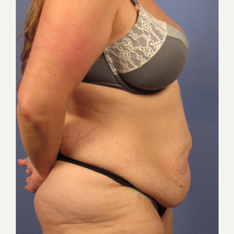 35-44 year old woman treated with Tummy Tuck before 3106717