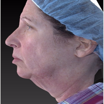 55-64 year old woman treated with Neck Lift before 3266939
