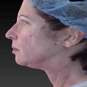 55-64 year old woman treated with Neck Lift after 3266939