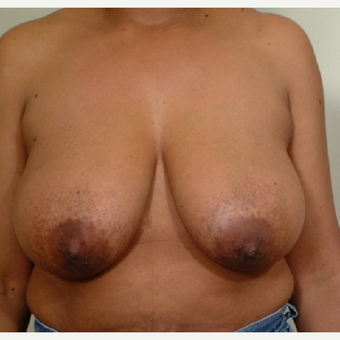 45-54 year old woman treated with Breast Reduction before 3446727
