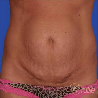 43 year old woman treated with a Standard Tummy Tuck before 3584926
