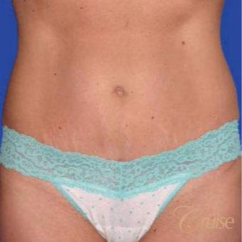 43 year old woman treated with a Standard Tummy Tuck after 3584926