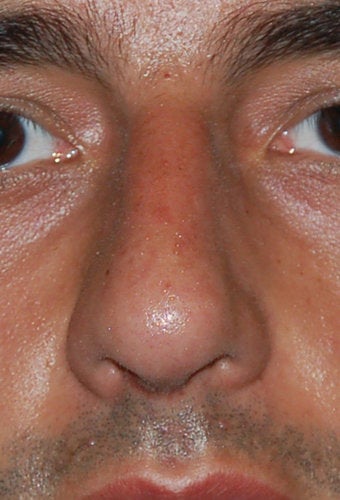 Rhinoplasty, Deviated Septum after 136232