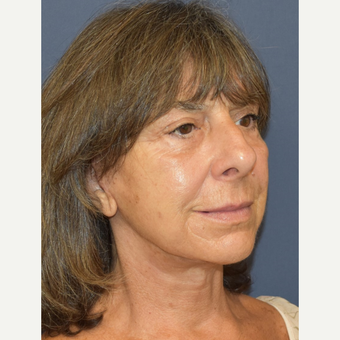 65-74 year old woman treated with Mini Lift after 3214005