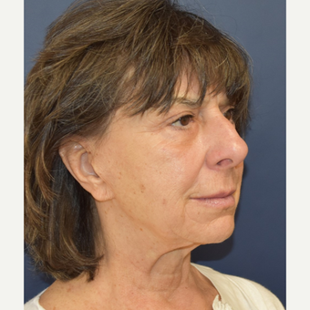 65-74 year old woman treated with Mini Lift before 3214005