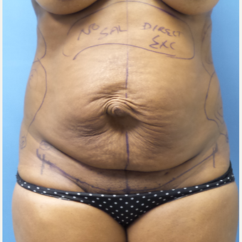 35-44 year old woman treated with Tummy Tuck before 3168438