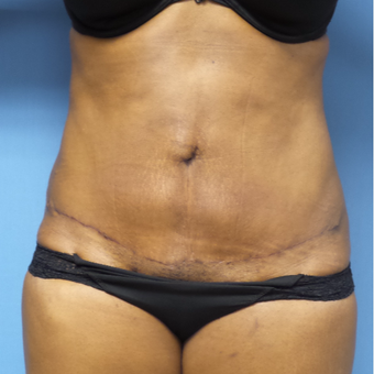 35-44 year old woman treated with Tummy Tuck after 3168438