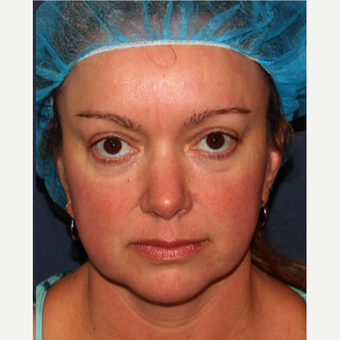 35-44 year old woman treated with IPL after 3340416