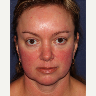 35-44 year old woman treated with IPL before 3340416