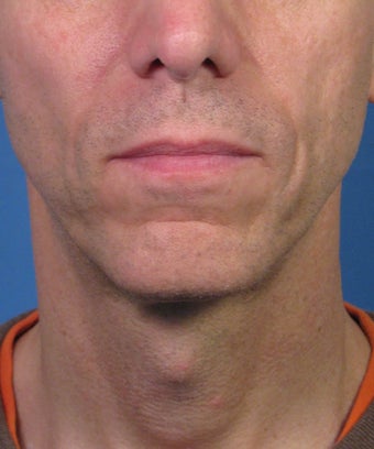 Direct Smile Line Excision Permanent Treatment for Nasolabial Folds after 979016