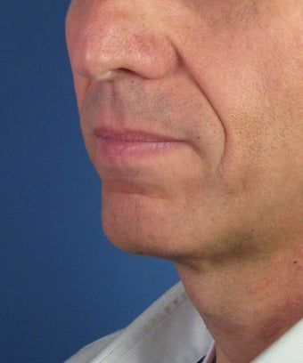 Direct Smile Line Excision Permanent Treatment for Nasolabial Folds 979016