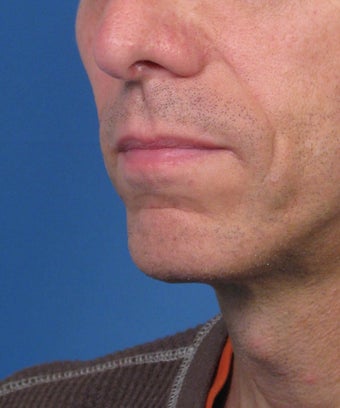 Direct Smile Line Excision Permanent Treatment for Nasolabial Folds 979016