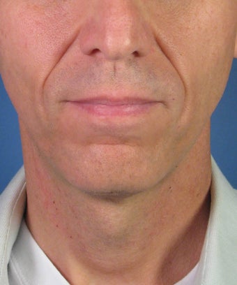 Direct Smile Line Excision Permanent Treatment for Nasolabial Folds before 979016