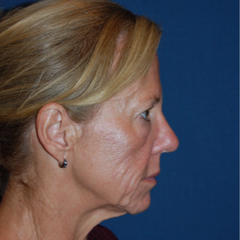 54 year old woman treated with Facelift before 3036705
