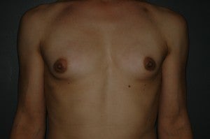 MTF trangender breast augmentation. Submuscular textured, shaped silicone implants. Incision under breast. before 1130786