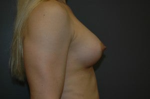 MTF trangender breast augmentation. Submuscular textured, shaped silicone implants. Incision under breast. 1130786