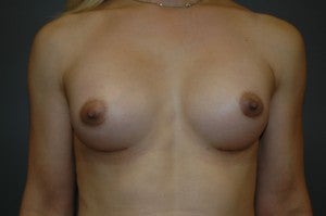 MTF trangender breast augmentation. Submuscular textured, shaped silicone implants. Incision under breast. after 1130786