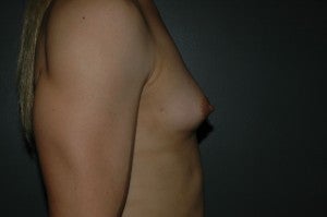 MTF trangender breast augmentation. Submuscular textured, shaped silicone implants. Incision under breast. 1130786
