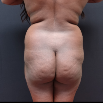 25-34 year old woman treated with Liposculpture before 3363892