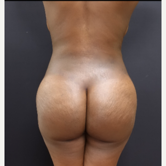 25-34 year old woman treated with Liposculpture after 3363892