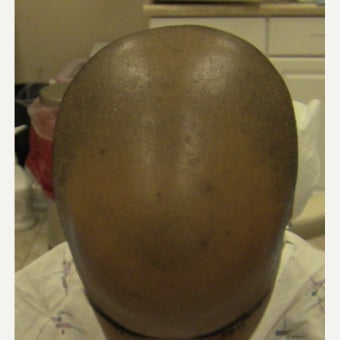 25-34 year old man treated with FUE Hair Transplant before 1753319