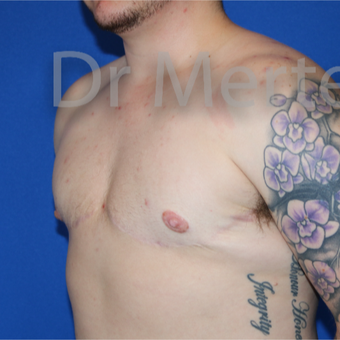 18-24 year old man treated with FTM Chest Masculinization Surgery after 3828897