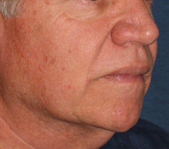 56 year old treated for red capillaries on nose, cheeks, and chin after 1480503