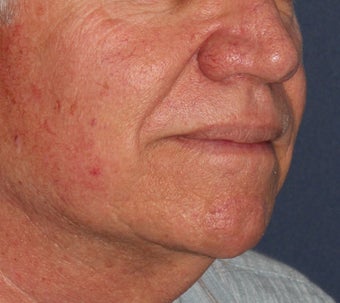 56 year old treated for red capillaries on nose, cheeks, and chin before 1480503