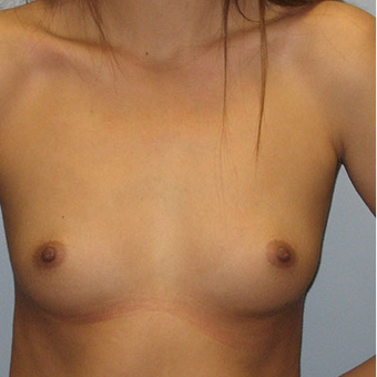 25 year old woman treated with Breast Augmentation before 3468364