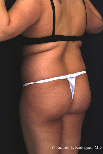 Brazilian Butt Lift before 101299