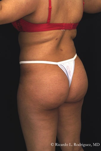 Brazilian Butt Lift after 101299
