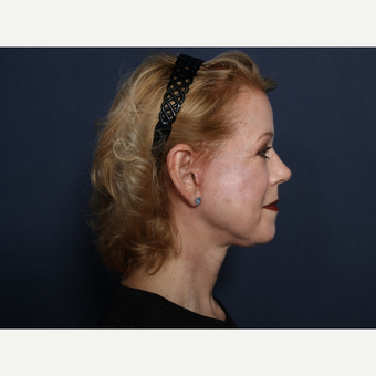55-64 year old woman treated with Neck Lift (view 2 of 2) after 3175518