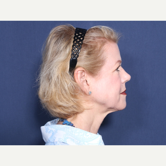 55-64 year old woman treated with Neck Lift (view 2 of 2) before 3175518