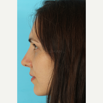 25-34 year old woman treated with Rhinoplasty after 3690808