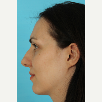 25-34 year old woman treated with Rhinoplasty before 3690808