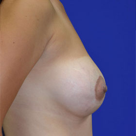 25-34 year old woman treated with Breast Lift with Implants after 3520056