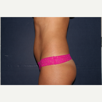 35-44 year old woman treated with SculpSure before 2930588