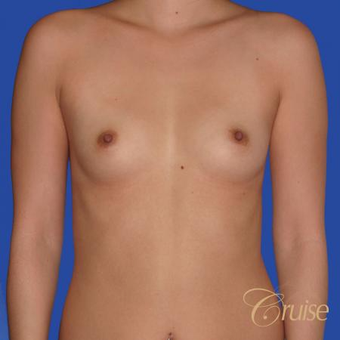 26 year year old woman treated with Saline Breast Implants before 3833221