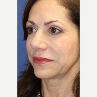 59 year old woman treated with an open secondary reconstructive rhinoplasty after 2621481