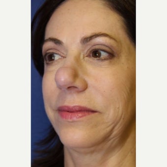 59 year old woman treated with an open secondary reconstructive rhinoplasty before 2621481