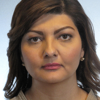 35-44 year old woman treated with Buccal Fat Removal before 3266536