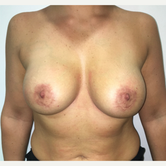 Breast Lift and circumareolar mastopexy after 3475729