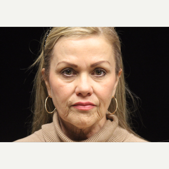 55-64 year old woman treated with Liquid Facelift before 3502817