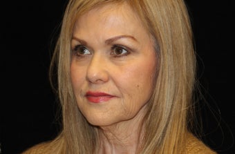 55-64 year old woman treated with Liquid Facelift 3502817