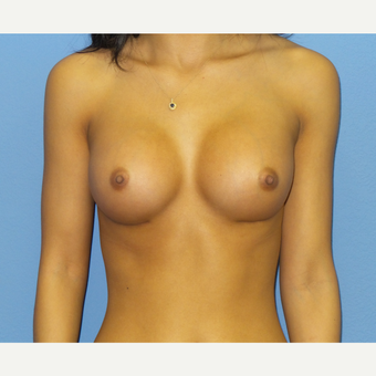 18-24 year old woman treated with Breast Augmentation after 3076800