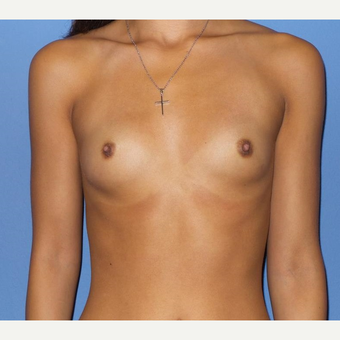 18-24 year old woman treated with Breast Augmentation before 3076800